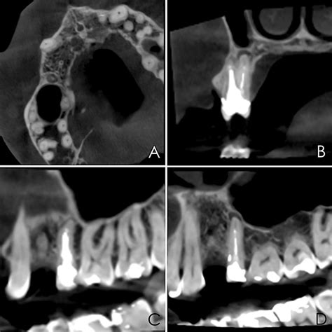 Endodontic Microsurgery Of An Anatomically Challenging Zone Using Dynamic Navigation A Case Report