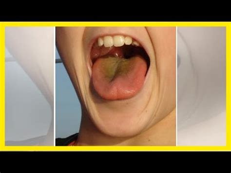 Yellow Tongue Causes Treatments And When To See A Doctor YouTube