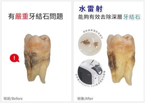 水雷射牙周治療 葉立維醫師 牙周專科｜植牙專科 桃園牙周病推薦首選