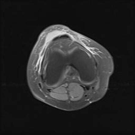 Prepatellar Bursitis Radiology Reference Article Radiopaedia Org