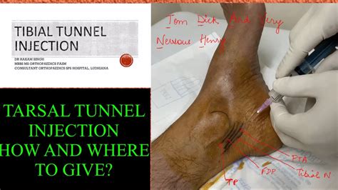 TARSAL TUNNEL INJECTION WHERE AND HOW TO GIVE IT DR HAKAM SINGH YouTube