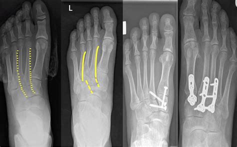 Lisfranc Fracture Dislocation A Review Of A Commonly Missed Injury Of