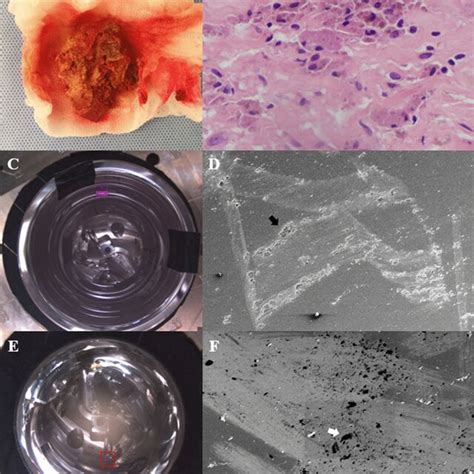 A Gross Pathology Showing Debris Deposited Soft Tissue Obtained From Download Scientific