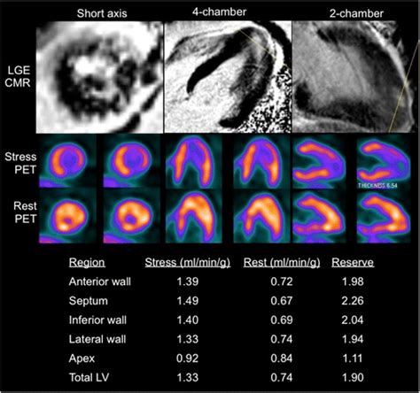 Cardiac Magnetic Resonance And Rest Regadenoson N Ammonia Pet Ct In