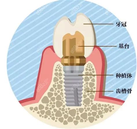 种植牙多少钱一颗2023价格表发布，含单颗半口全口收费种植牙 8682赴韩整形网