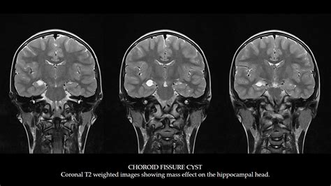 Ultimate Radiology : Choroid Fissure Cyst