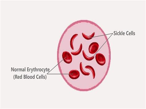 Sickle Cell Anemia Treatment Cost In India Best Doctor Hospital