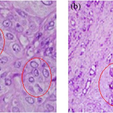 Raman Spectrum Of The Breast Lesion A Normal And B Cancerous