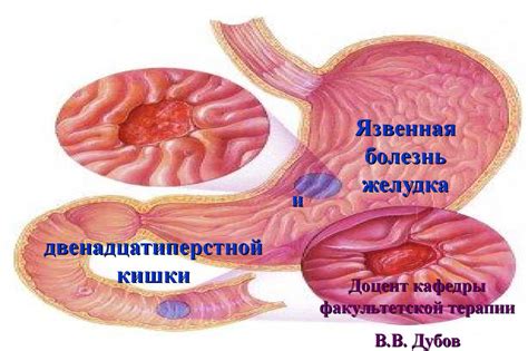 Язвенная болезнь желудка и двенадцатиперстной кишки - online presentation