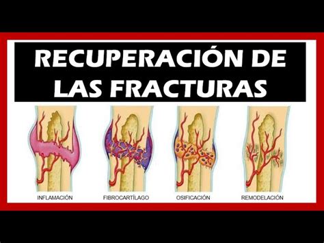 Como Saber Si Una Fisura De Hueso Esta Sanando Outlet Smarys Org