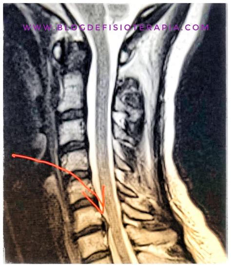 Hernia Discal Cervical Blog De Fisioterapia