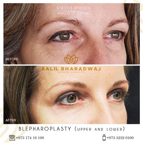 Blepharoplasty Gallery - Smile Studios - Best Medical Center in Bahrain ...