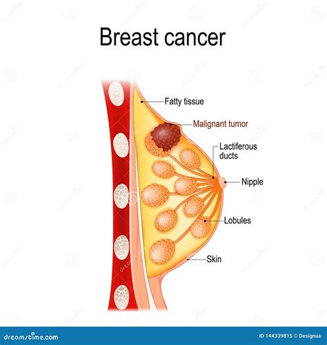 Cancro Della Mammella Sezione Trasversale Della Ghiandola Mammaria Con