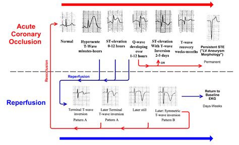 Acute Myocardial Infarction A Shifting Paradigm Recapem