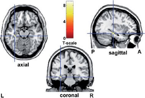 A Comparison Of Healthy Age And Sex Matched Control Subjects Showed Download Scientific Diagram