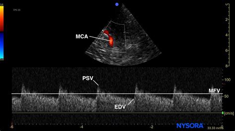 Evaluación Del Vasoespasmo Cerebral Con Doppler Transcraneal Una Guía