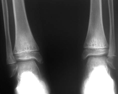 Imaging Of Chronic Recurrent Multifocal Osteomyelitis RadioGraphics