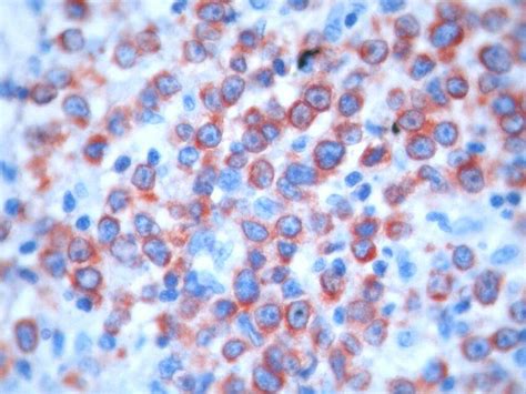 Bcl 2 Staining X 400 A Case With A Round Cell Morphology And High