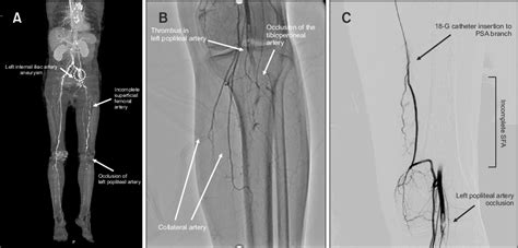 Figure From Catheter Directed Thrombolysis For Persistent Sciatic