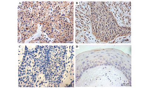 Expression And Correlation Of NRF2 KEAP1 NQO 1 And HO 1 In Advanced