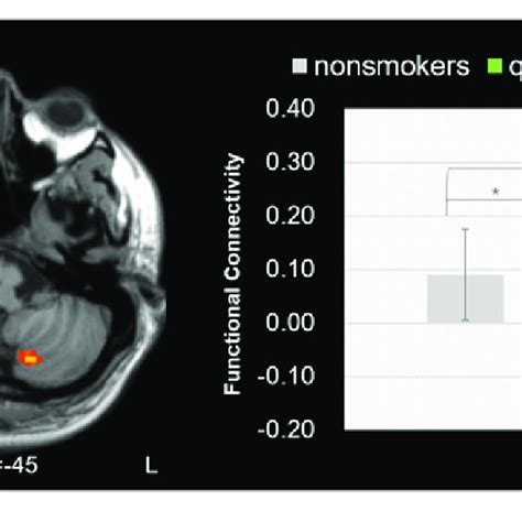 Functional Connectivity Between The Left Dorsomedial Thalamus And