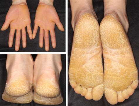 Figure 2 From Hereditary Palmoplantar Keratoderma Clinical And Genetic