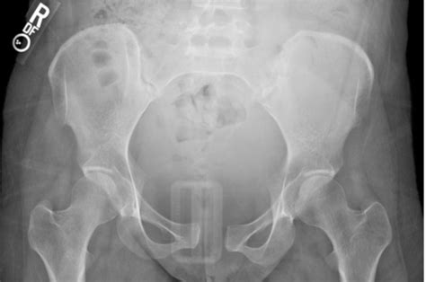 Figure 2 From Postpartum Symphysis Pubis Diastasis Semantic Scholar