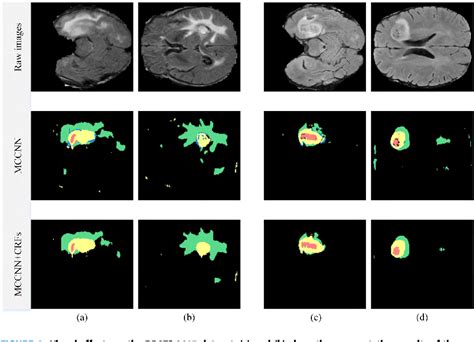 Figure 6 From Brain Tumor Segmentation Using Multi Cascaded