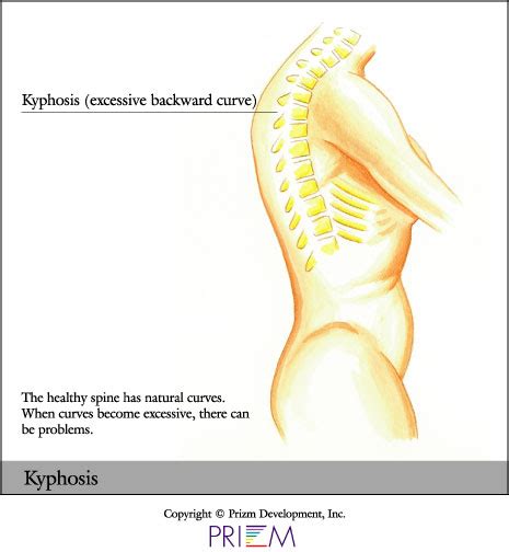 Kyphosis | Scoliosis Texas