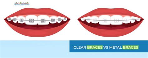 Clear Braces vs Metal Braces Pros & Cons: Comparison Guide