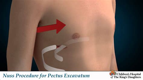 Nuss Procedure For Pectus Excavatum Youtube