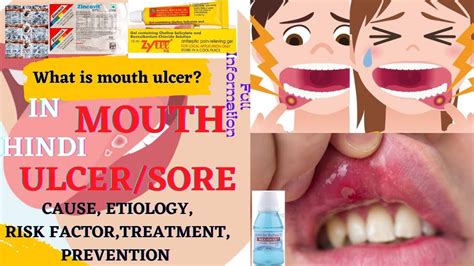 What Is Mouth Ulcers Types Cause Symptoms Treatment Complications