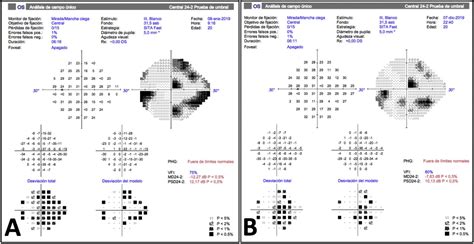 Permanent Damage Of The Inner Retinal Layers In A Patient With Migraine