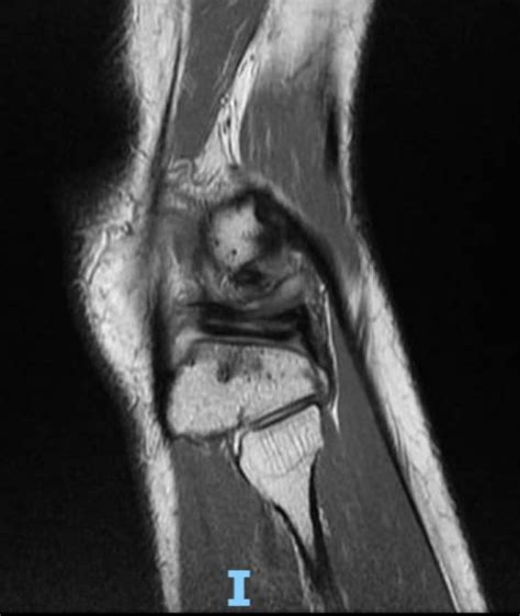 Horizontal Cleavage Tear Hct Of Meniscus With Meniscal Cyst