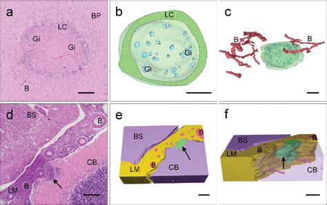 Non Necrotizing Granuloma And Border Zone Encephalitis A