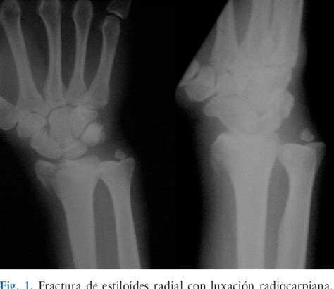 Figure From Fractura Luxaci N Radiocarpiana Transestiloidea Con