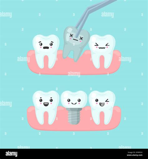 Tooth Extraction And Implantation Stomatology Concept Cute Colorful