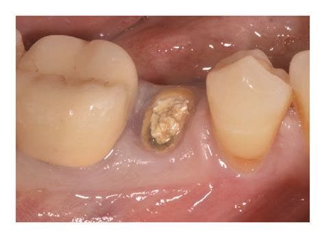 Immediate Implant Placement Of A Mandibular Second Premolar