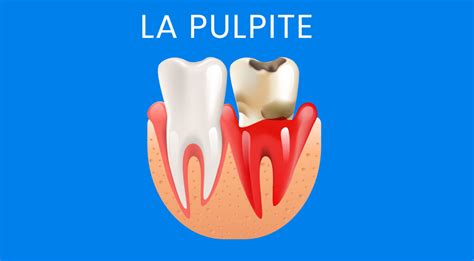 La pulpite cos è sintomi e cura Studio dentistico Ireos dental