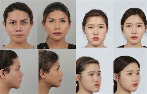 Korean Celebrity Without Plastic Surgery Plastic Surgery In Market