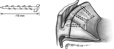 Meniscal Injuriesrepair Arrow Musculoskeletal Key