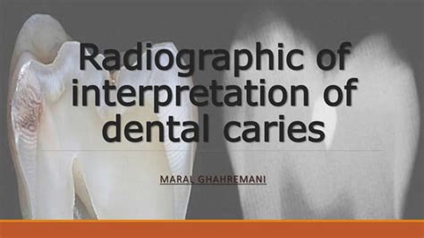 Dental Caries And Anomalies In Radiograph