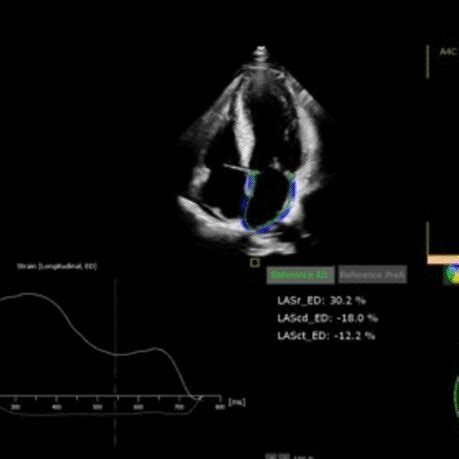 Assessment Of Left Atrial And Left Ventricular Functions And Pressures