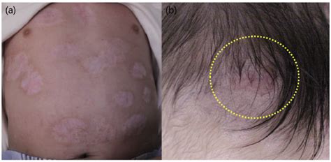 A Case Of Aplasia Cutis Congenita With Widespread Multifocal Skin