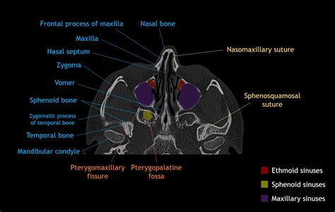 Nasal Bone Anatomy Axial