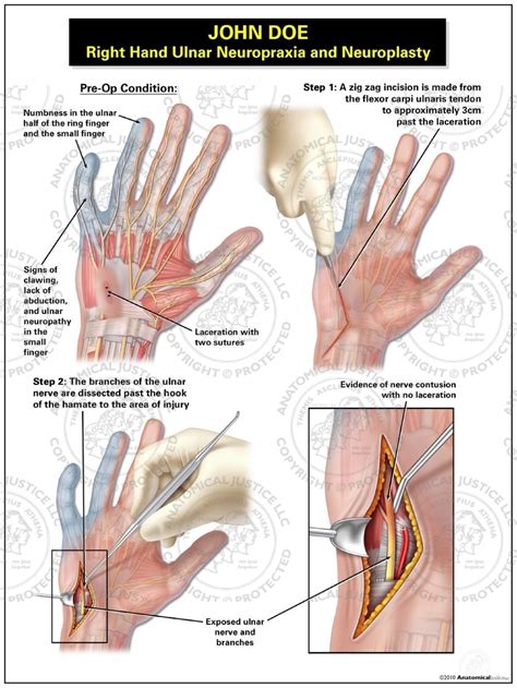 Right Hand Ulnar Neuropraxia And Neuroplasty Ulnar Nerve Contusion