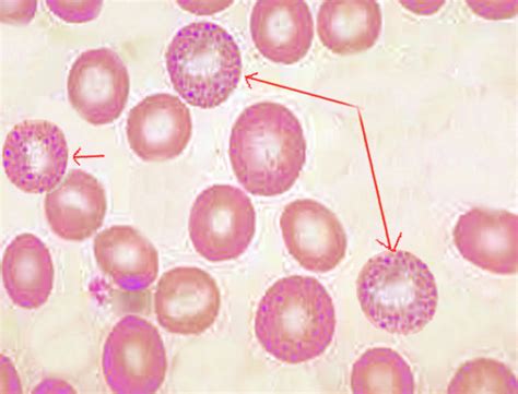 [figure Basophilic Stipling Image Courtesy Dr Chaigasame] Statpearls