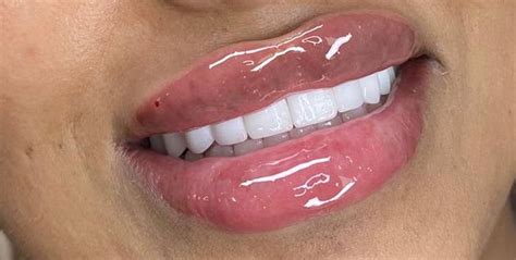 Lip Masterclass Training Russian Lips Course — Aesthetics Lounge Academy