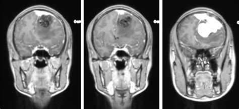 Hemangiopericytoma – Radiology Cases