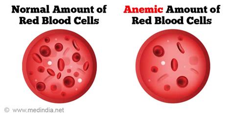 Ampullary Cancer Symptoms - CancerWalls